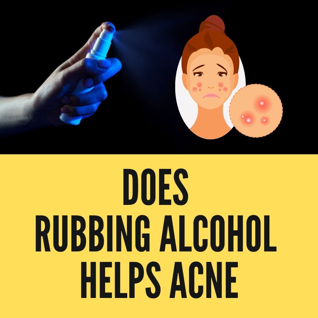 Does Rubbing Alcohol Help Acne? 5 Methods